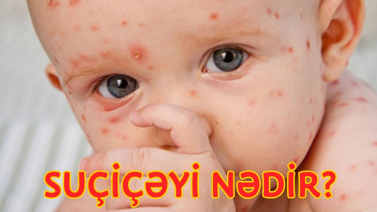 Suçiçəyini necə müalicə etmək lazımdır?