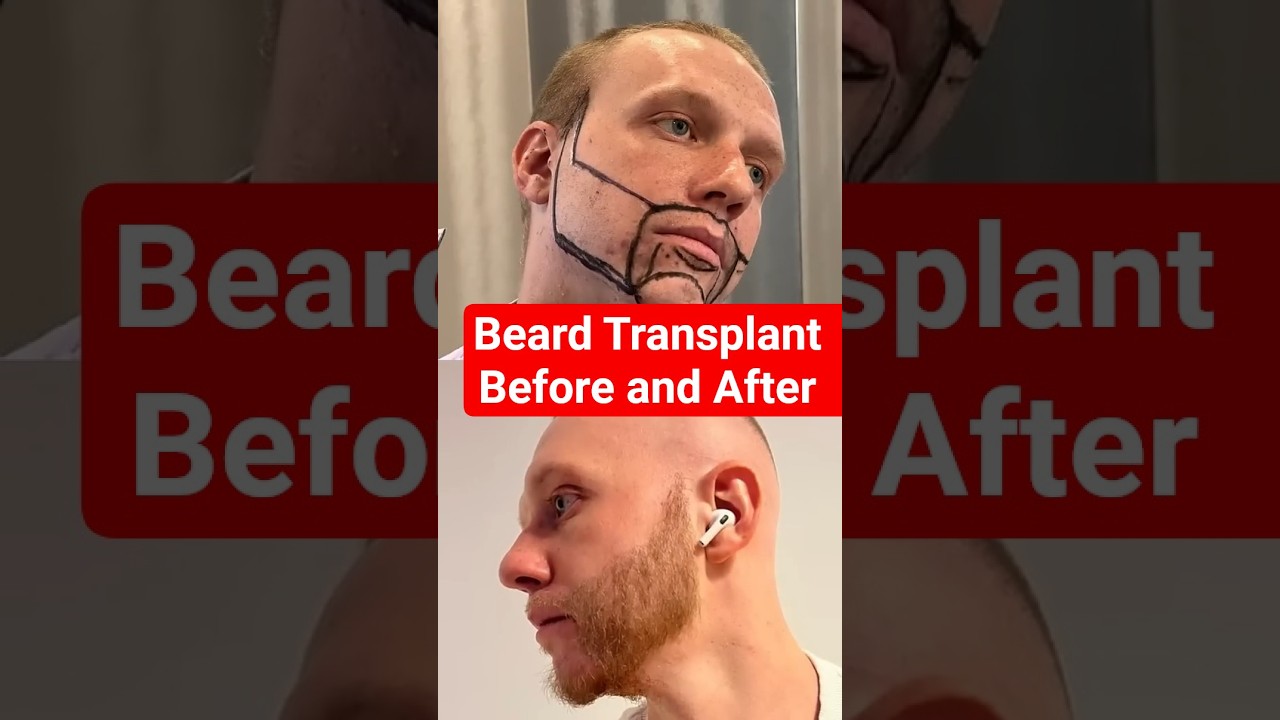 Beard Transplant Result | Beard Transplant Before and After 5000 Grafts Result 12 months timelapse