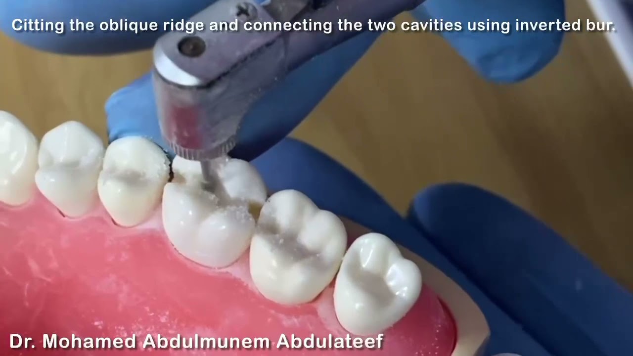 Class II (MOD) cavity preparation for amalgam restoration in maxillary first molar.