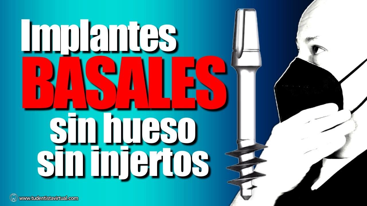 NUEVOS IMPLANTES ESTRATÉGICOS NO NECESITAN HUESO