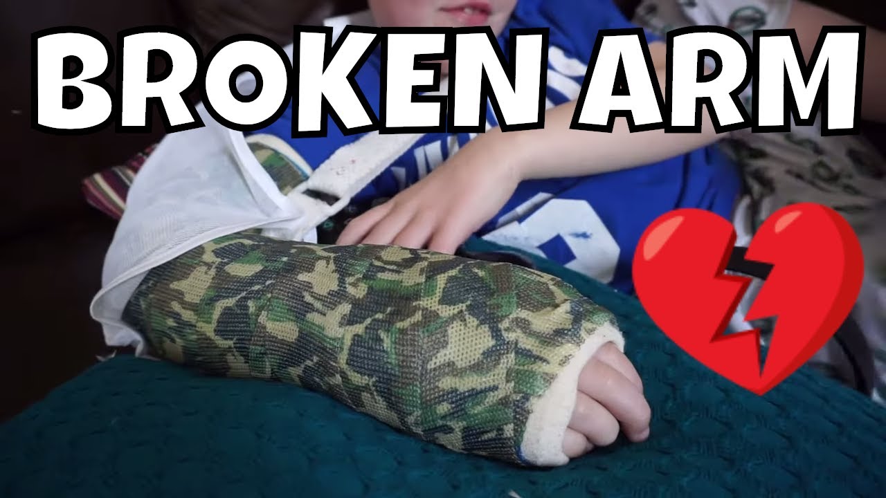 OWEN'S BROKEN ARM WEEK TWO!