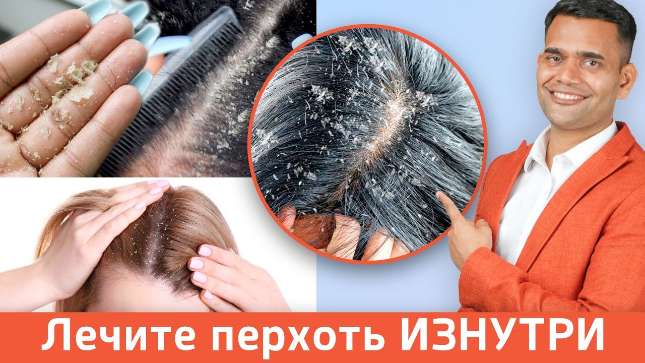 ЛЕЧЕНИЕ ПЕРХОТИ БЕЗ ШАМПУНЕЙ.