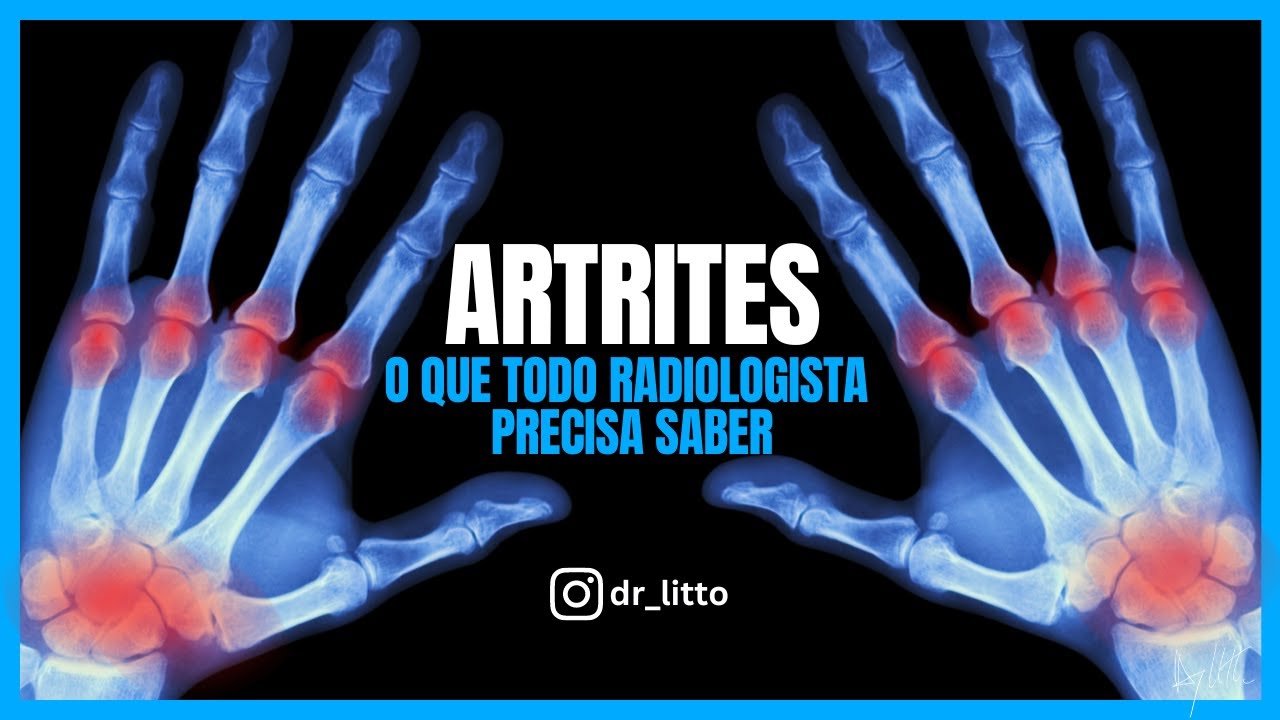 ARTRITES: O que TODO RADIOLOGISTA PRECISA SABER