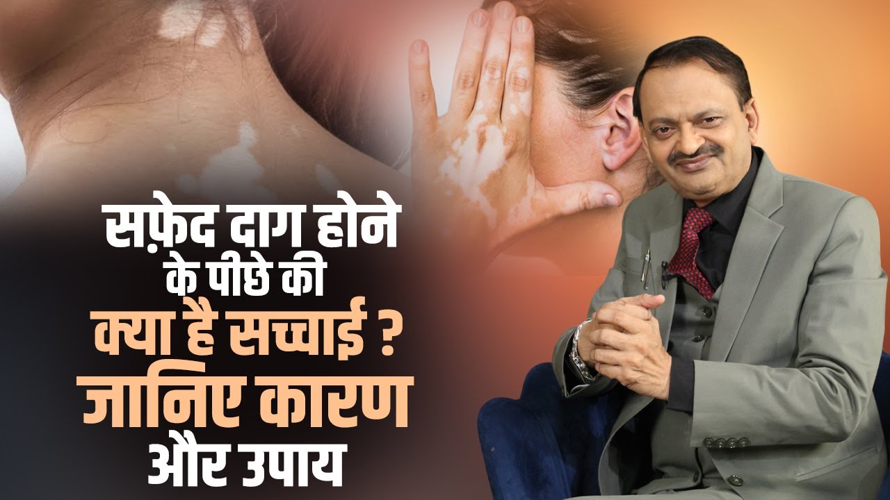 सफ़ेद दाग होने के पीछे की क्या है सच्चाई ? जानिए कारण और उपाय | Subhash Goyal