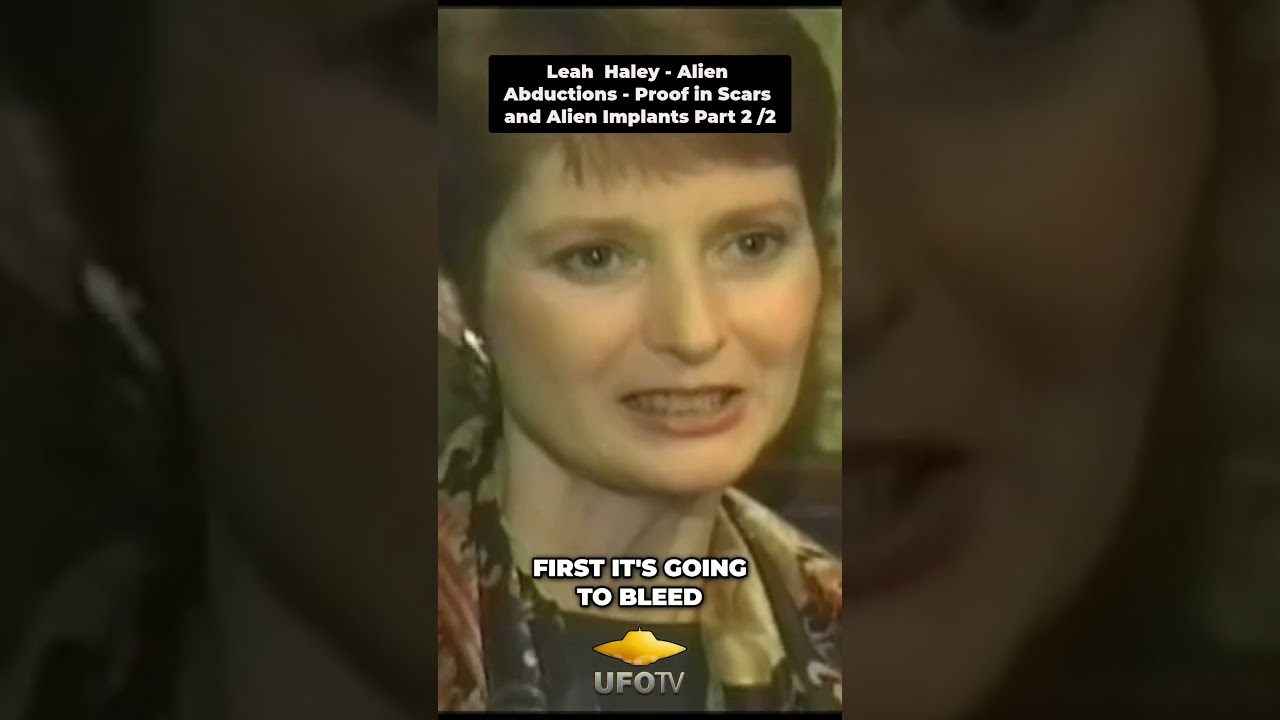 Alien Abductions - Proof in Scars and Alien Implants Part 2:2
