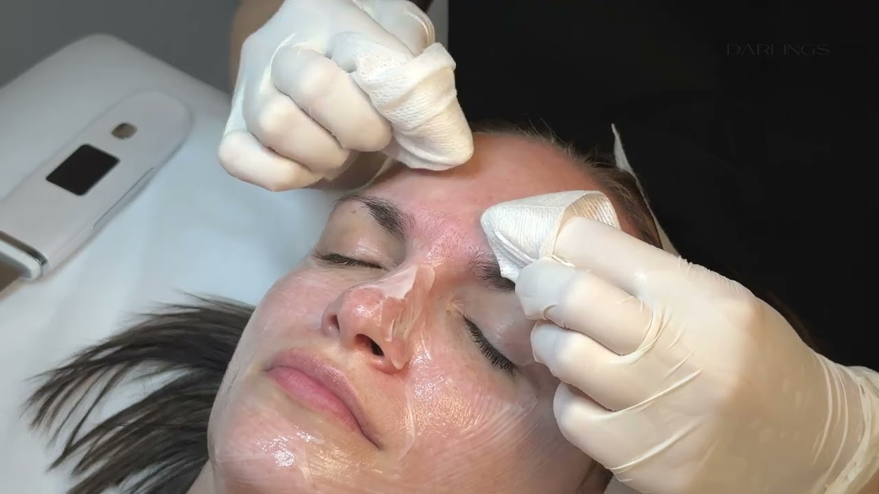 Deep pore cleansing with a chemical peel ar Darlings Beauty Lab