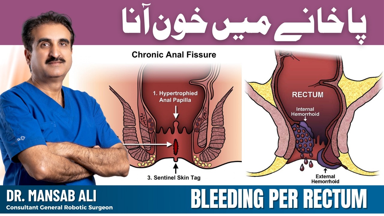 Bleeding Per Rectum – Causes, Warning Signs & When to See a Doctor | Dr. Mansab Ali
