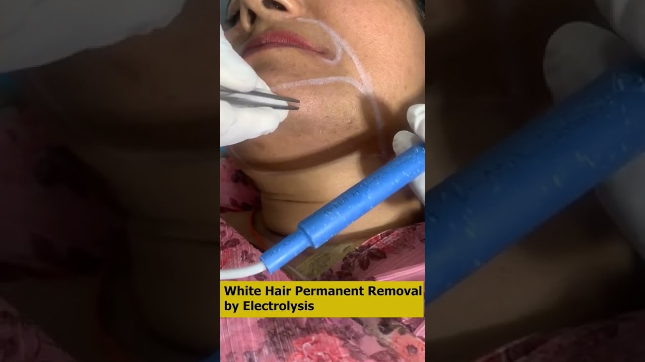 White Hair Permanent Removal by Electrolysis. 