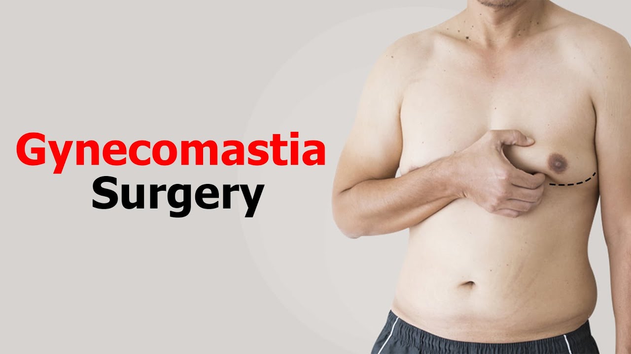 Man Boobs ! Gynecomastia Surgery ( Permanent Result ) By Dr. Prashant Yadav @dezireclinic