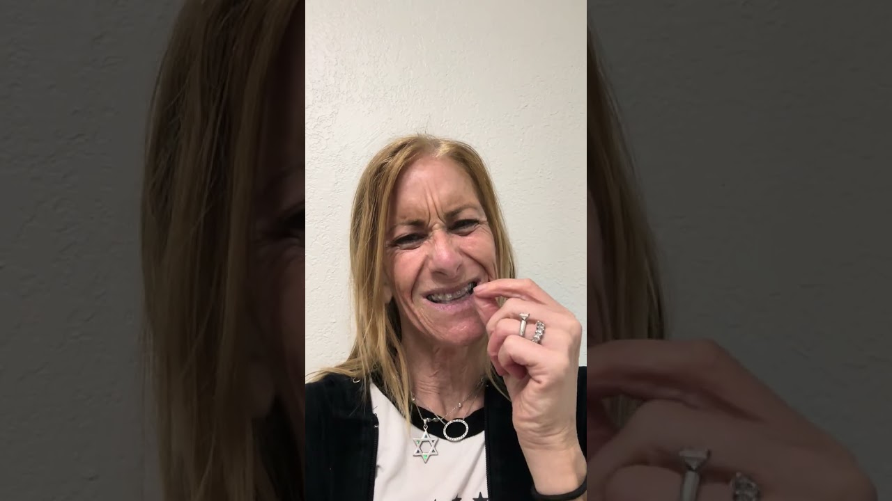 #adultorthodontics Braces are on! @orthomikeorthodonticstv9749 