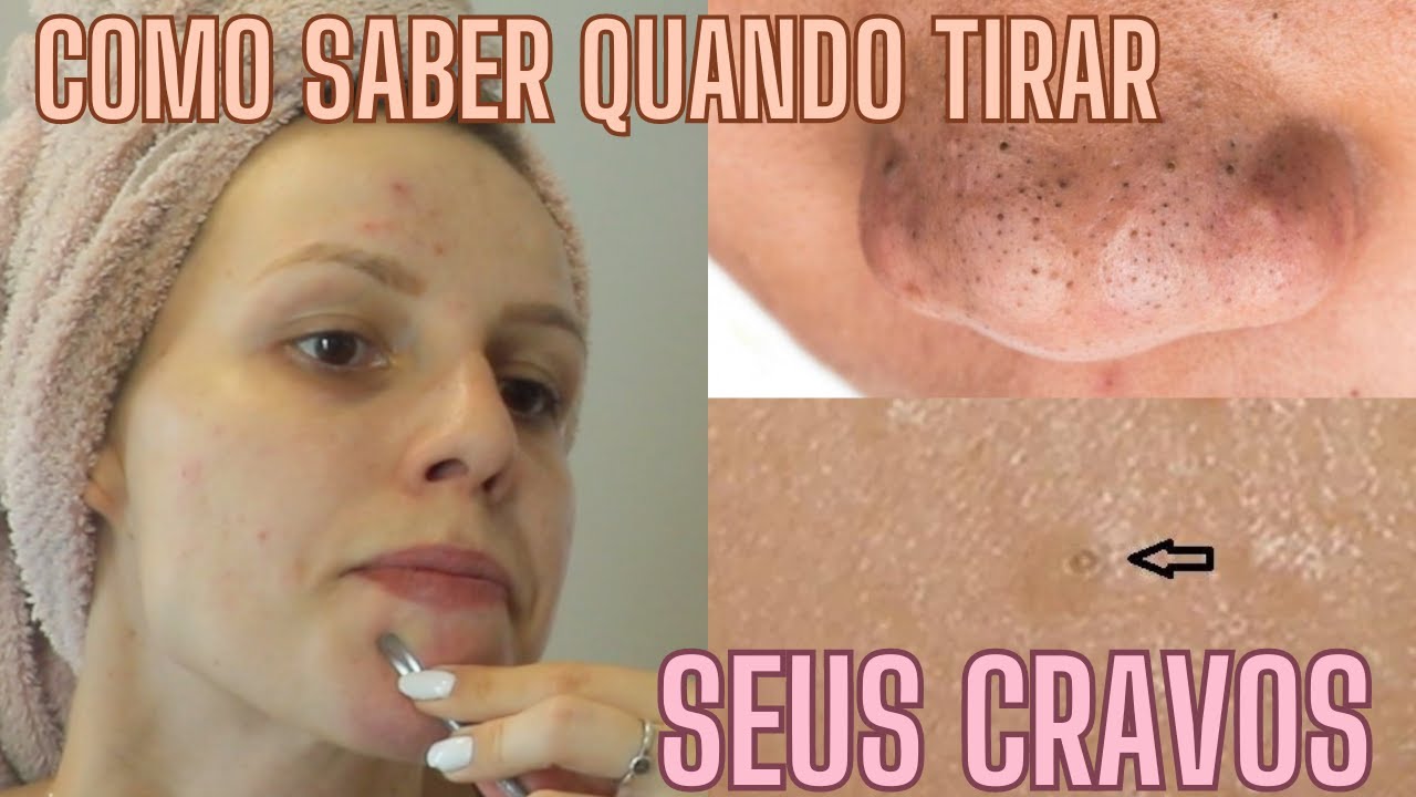 COMO SABER QUANDO EXTRAIR UM CRAVO -  Bruna Harmel
