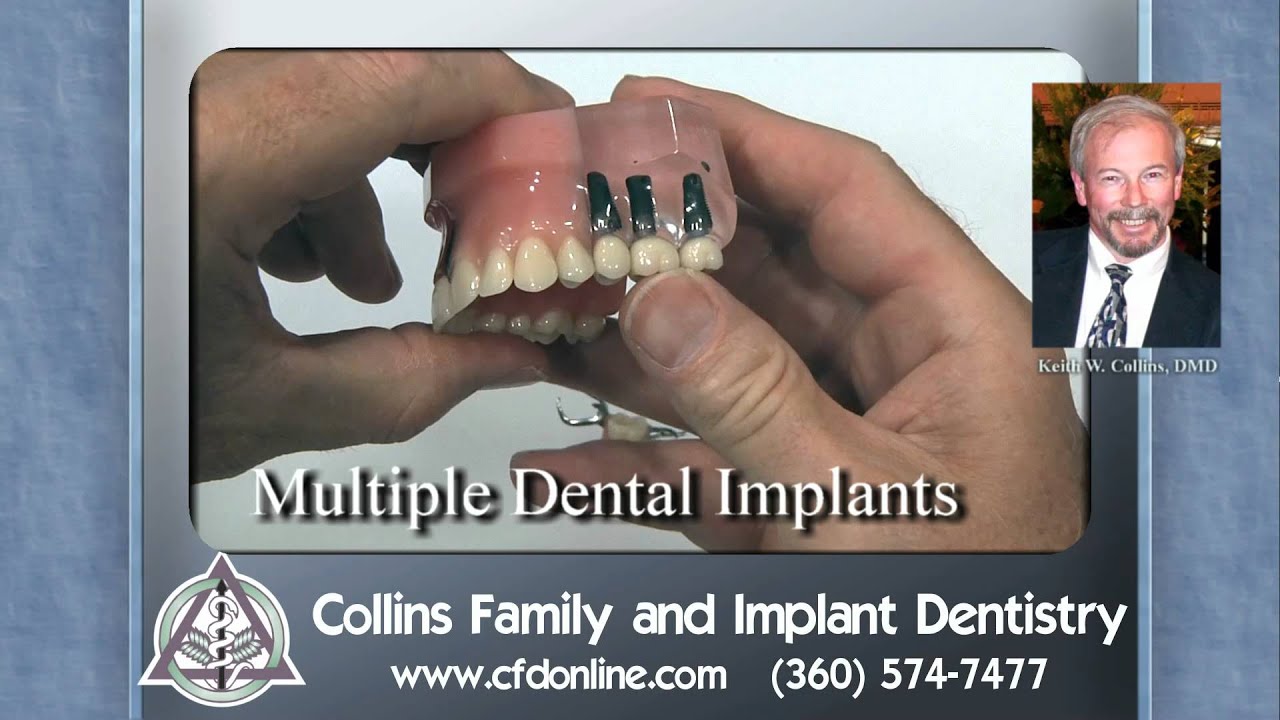 Partial dentures vs dental implants, by Collins Family and Implant Dentistry, Vancouver, WA