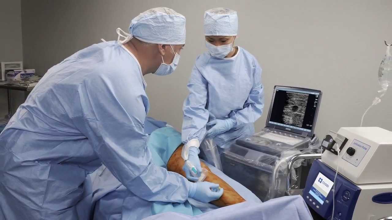 Técnica de varices por radiofrecuencia - Hospital San Juan de Dios de León