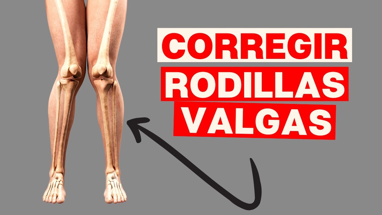 Como Corregir las RODILLAS VALGAS (Piernas en X)