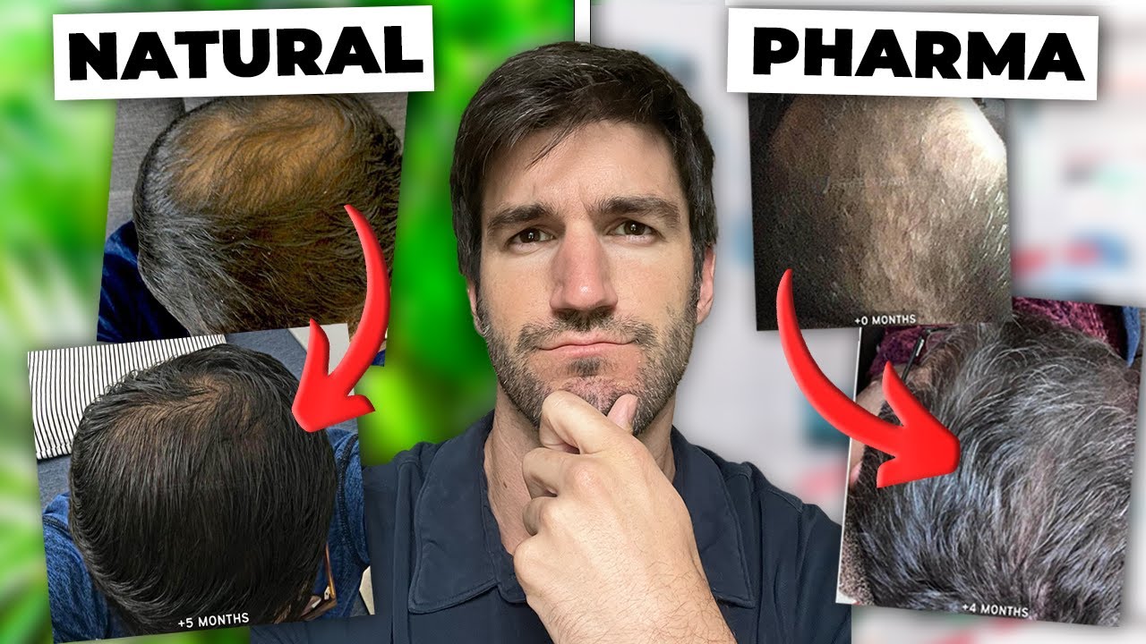 All-Natural vs Pharma Hair Loss Treatments: The TRUTH