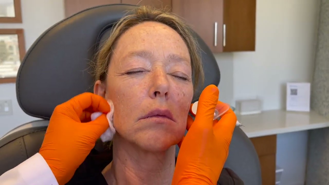 Los Angeles Restore Facial Volume | Santa Monica Tighten Sagging Jowls | Facial Fillers