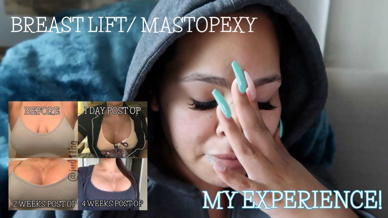 MY BREAST LIFT + IMPLANTS RECOVERY| BEFORE & AFTER PICS
