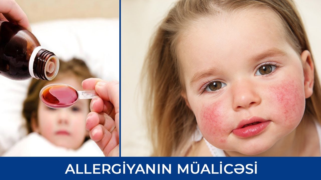Uşaqlarda allergiyanın müalicəsi - Şəhla Mustafayeva ( Pediatr-allerqoloq )