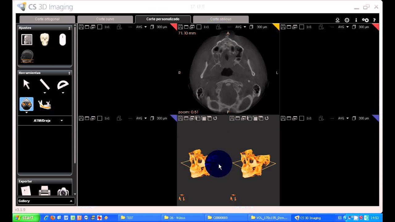 Tutorial CS 3D imaging software. 13-Carestream. Corte personalizado.avi