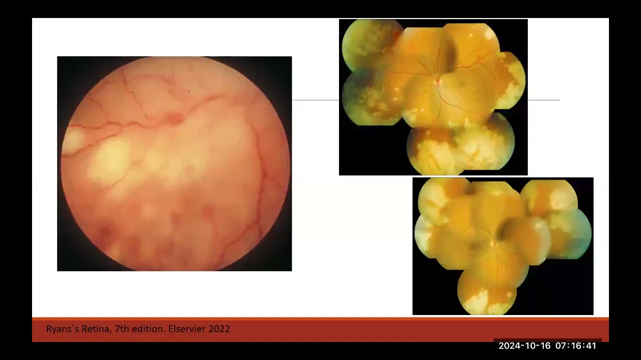 Necrosis Retinal Aguda.  Dr Santiago Betancur. 2024_10_16