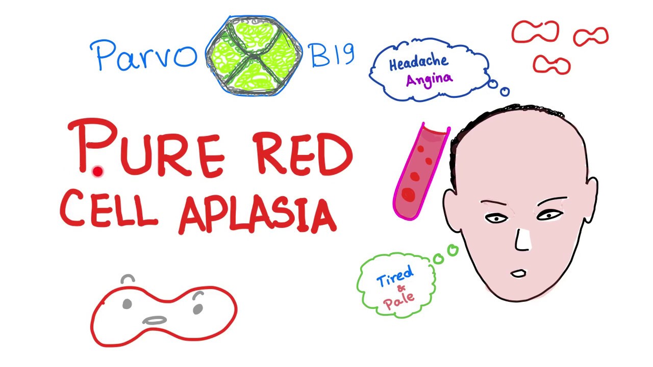 Pure Red Cell Aplasia (PRCA) - Parvo B19 Virus - Hematology