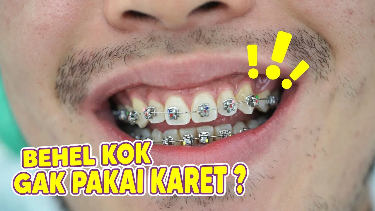 PROSES PEMASANGAN BEHEL SELF LIGATING, Behel Gigi Tanpa Karet