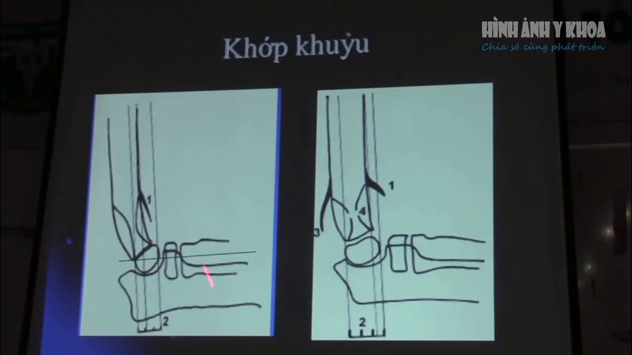Chấn thương xương trẻ em, Bs Tuấn
