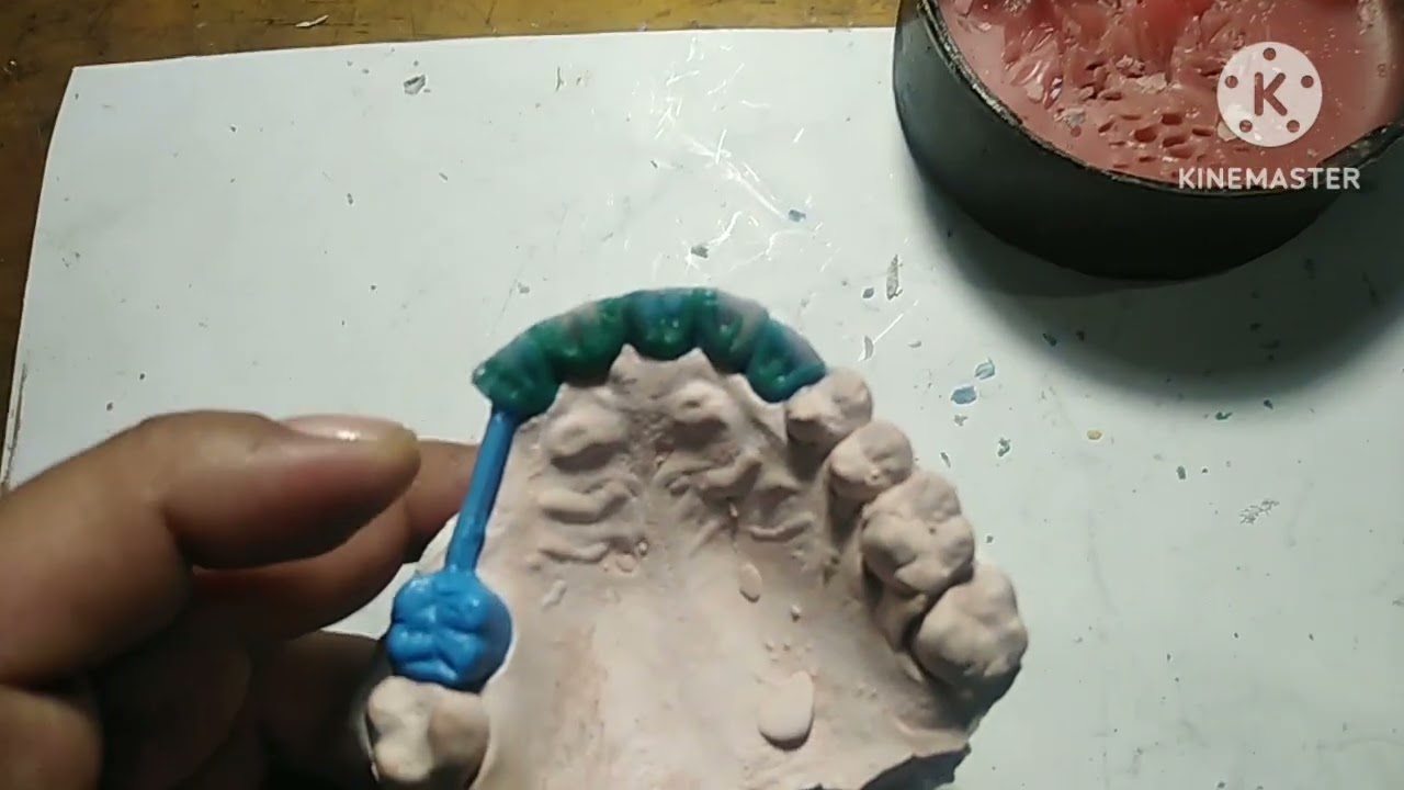 Prótesis dentales cómo acer tus puentes fijos de metal acrílico