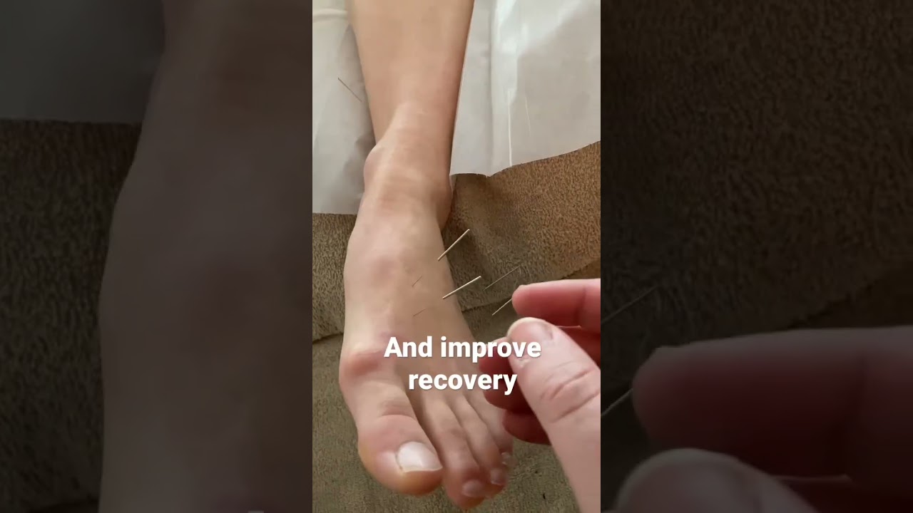 Acupuncture for ankle injury and recovery #acupuncture #treatment