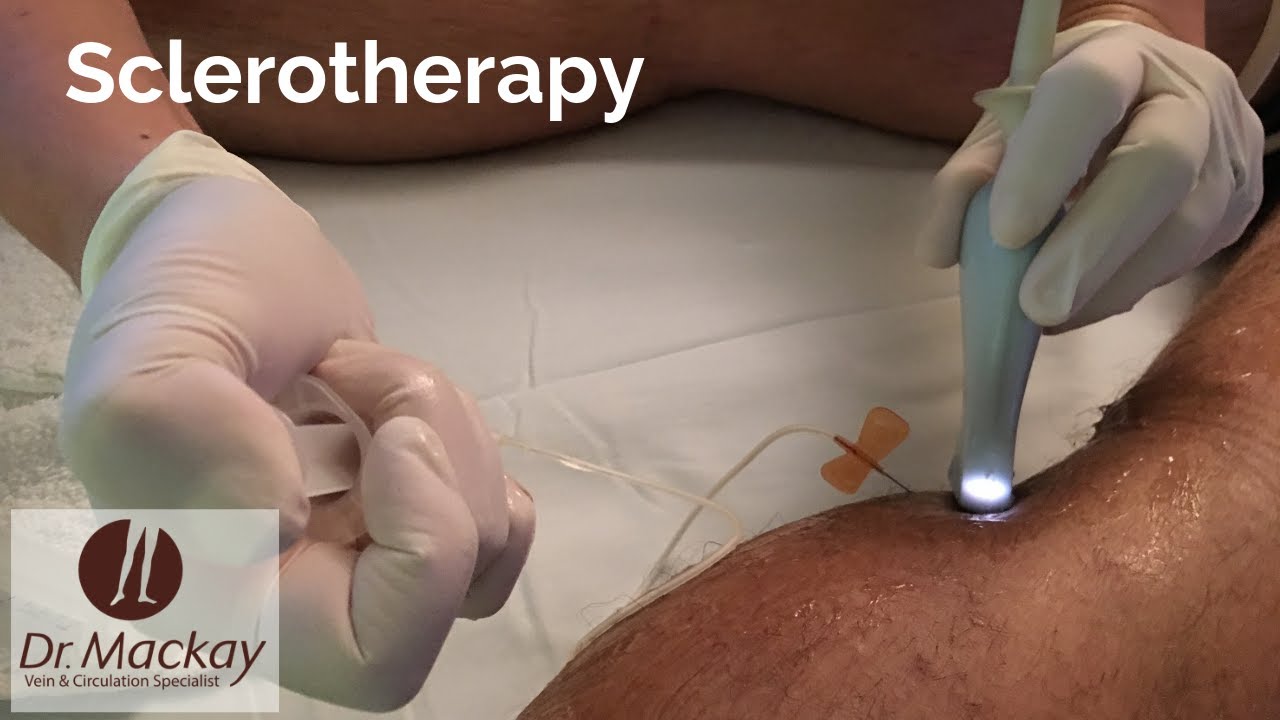 All About Sclerotherapy Procedure for Varicose Veins