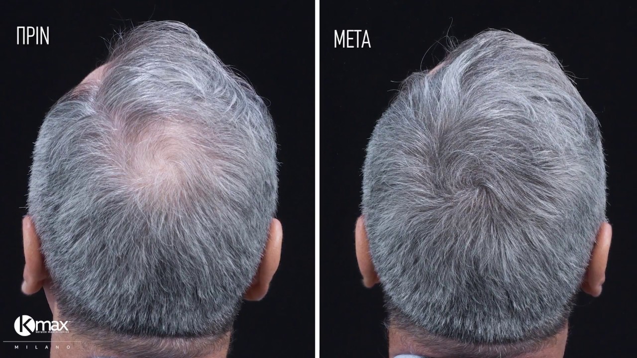 KMax Milano fibers for thining hair - &Kappa;ά&lambda;&upsilon;&psi;&eta; &kappa;&omicron;&rho;&upsilon;&phi;ή&sigmaf; - &Pi;&upsilon;&kappa;&nu;ά &mu;&alpha;&lambda;&lambda;&iota;ά &sigma;&epsilon; &lambda;&iota;&gamma;ό&tau;&epsilon;&rho;&omicron; &alpha;&pi;ό 1 &lambda;&epsilon;&pi;&tau;ό!
