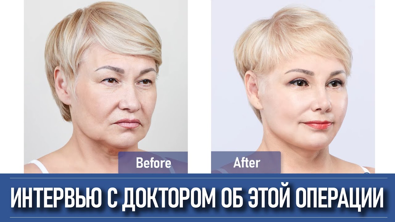 Лифтинг лица в Корее - разбор кейса невероятного преображения