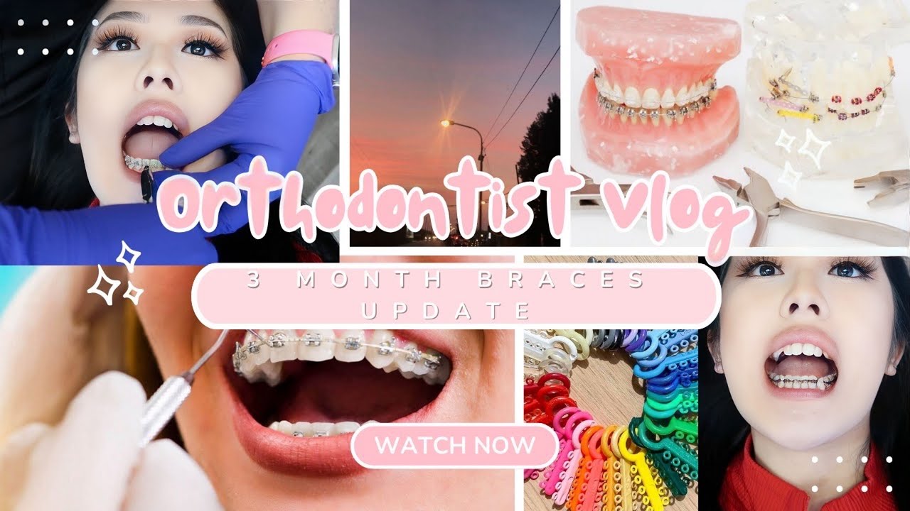 BRACES VLOG EP.5: 3 MONTH BRACES UPDATE + GOOD NEWS!?, wire changed, braces color, power chain