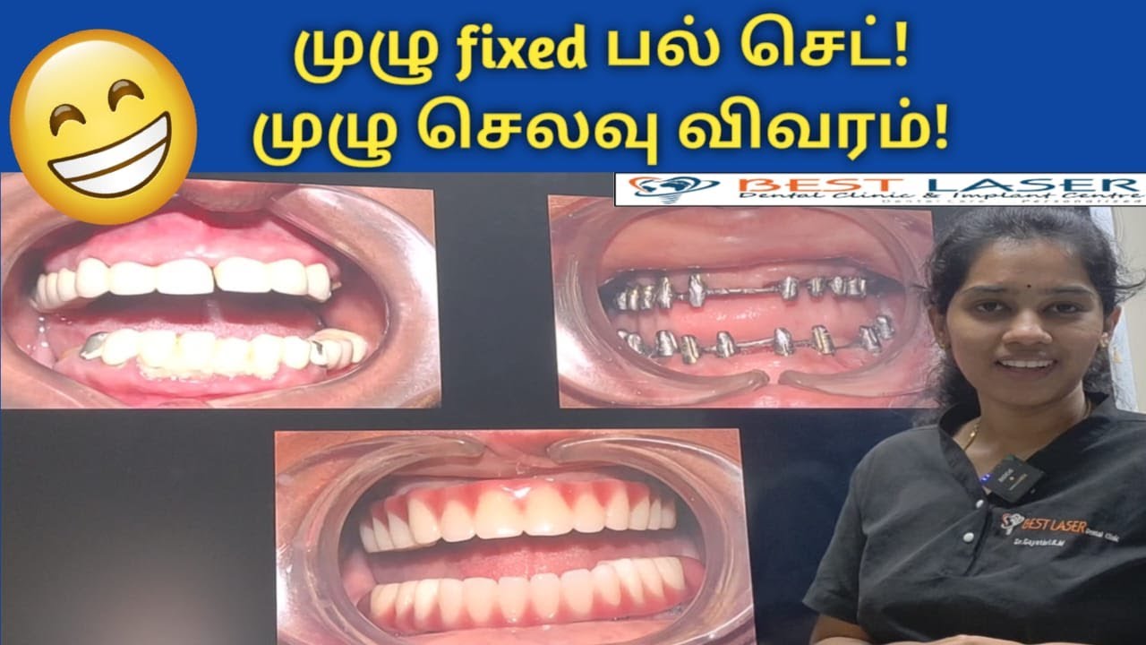 70வயதில் முழு fixed பல் செட் மூலம் நிரந்தர தீர்வு! செலவு மற்றும் செயல்முறை விளக்கம்!