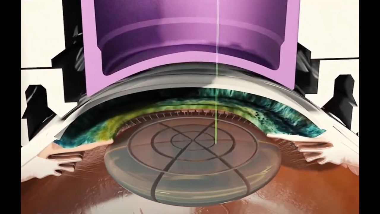 L'intervento di cataratta con lenti EDOF e multifocali