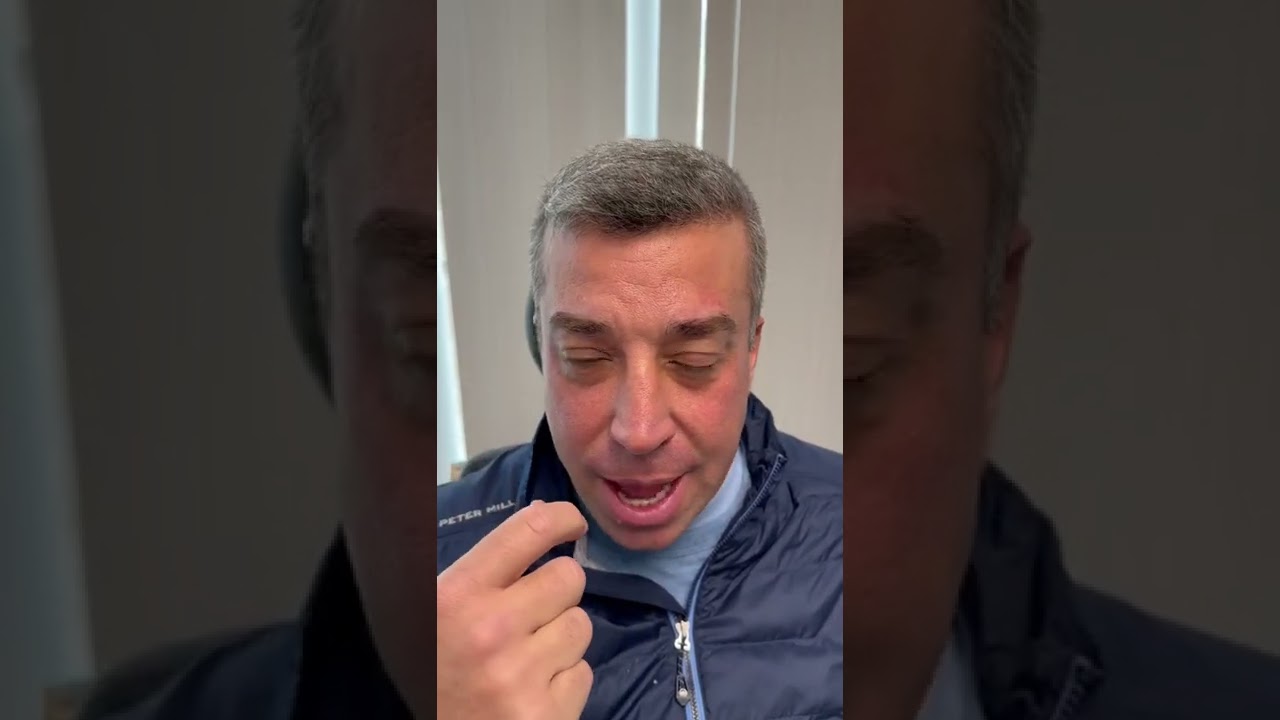 1 week post septoplasty, endoscopic sinus surgery, nasal valve repair and UPPP-doing well