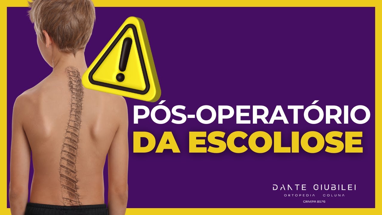 COMO É O PÓS-OPERATÓRIO DA CIRURGIA DE ESCOLIOSE? | Dr. Dante Giubilei