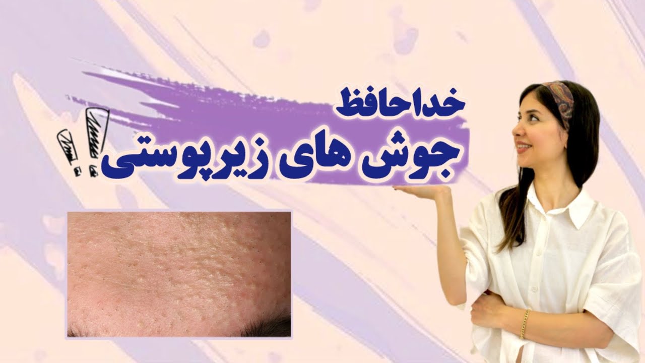 ترفندهای درمان سریع جوشهای زیرپوستی