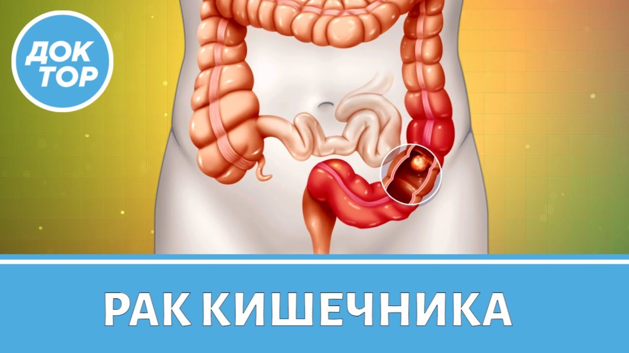 Колопроктолог Бадма Башанкаев рассказывает про рак кишечника