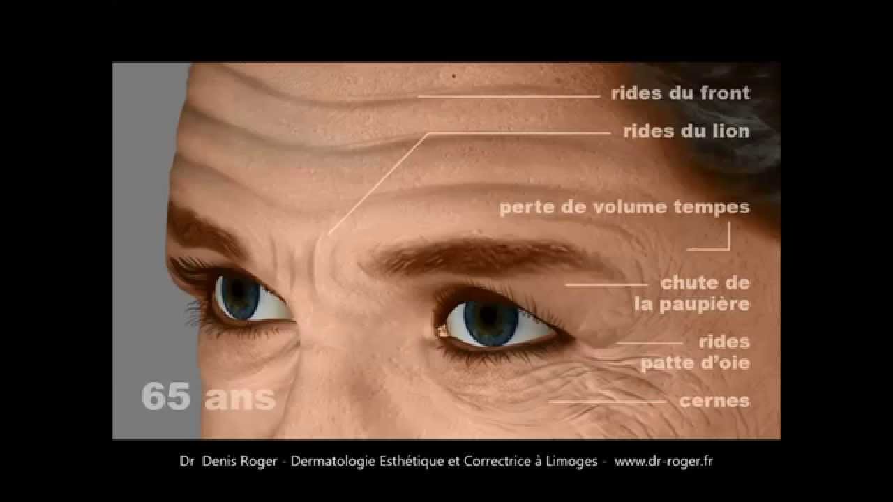 Injection de Botox à Limoges. Traitement des rides du front, patte d'oie, du lion)