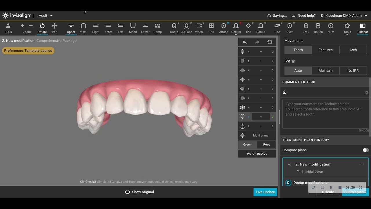 Invisalign Providers- Watch this if You Want to See a Common Clincheck Error