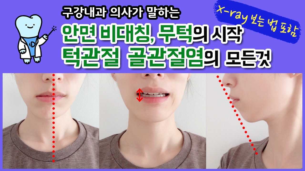 안면비대칭, 무턱의 원인, 턱관절 퇴행성 관절염, 마모의 원인과 엑스레이 보는법까지 구강내과의사가 완벽분석 해드림.