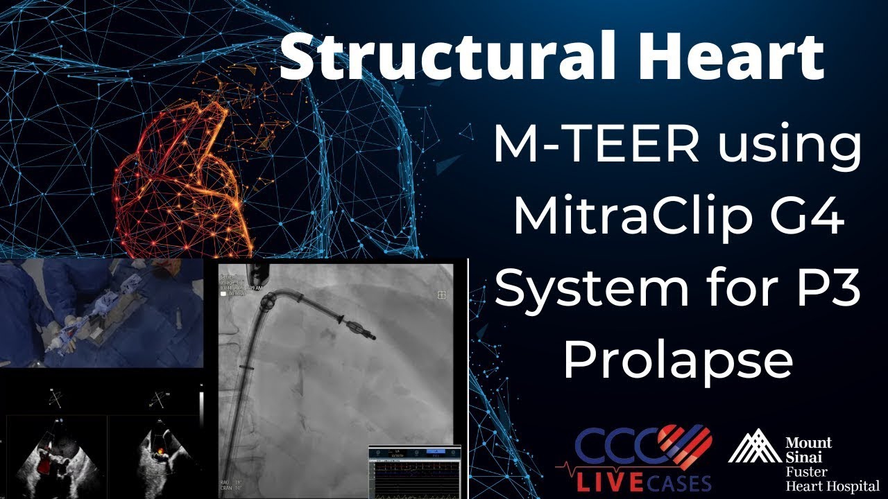 M-TEER using MitraClip G4 System for P3 Prolapse