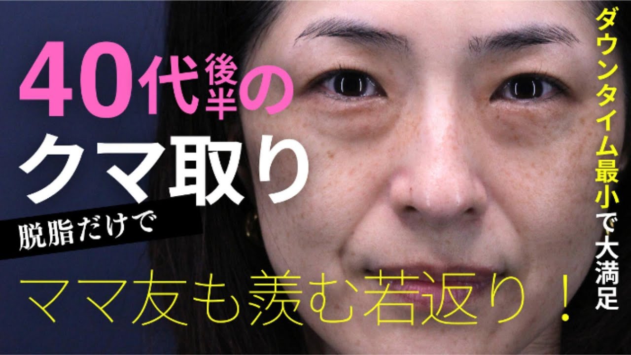 ママ友からも褒められた💛40代後半クマ取り実録✨