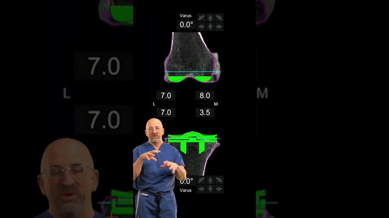 The Real Secret to Getting the BEST (customized) New Knee #shorts