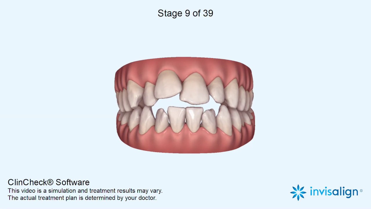 Invisalign: Clincheck