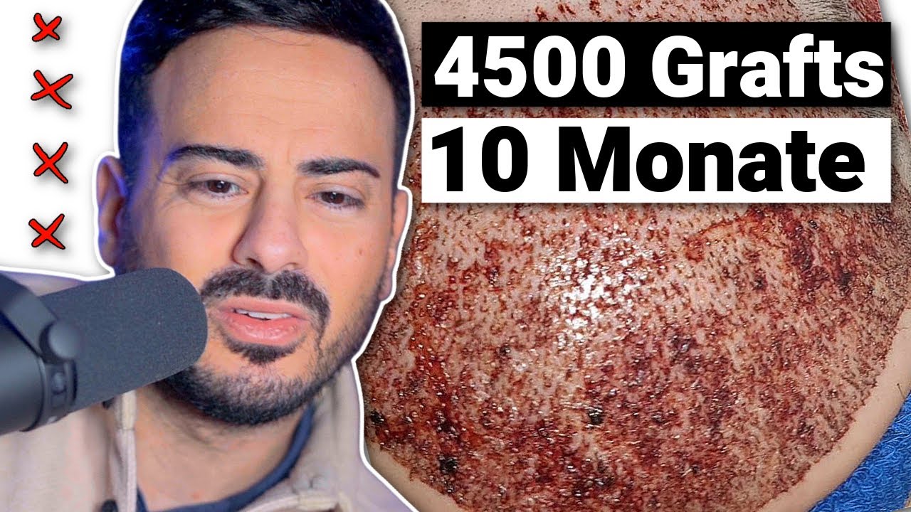 Haartransplantation Erfahrung | 10 Monate und 4500 Grafts