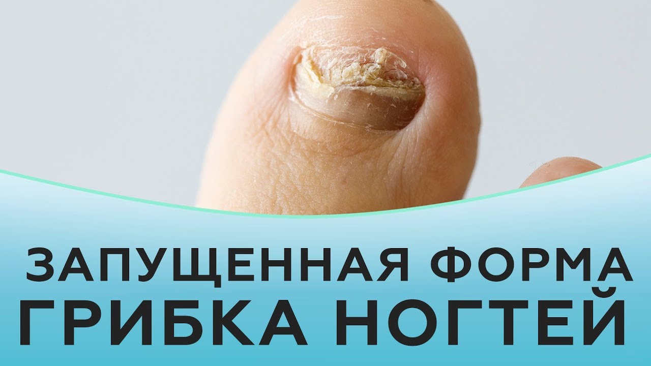 Грибок ногтей. Лечение запущенной формы грибка ногтей