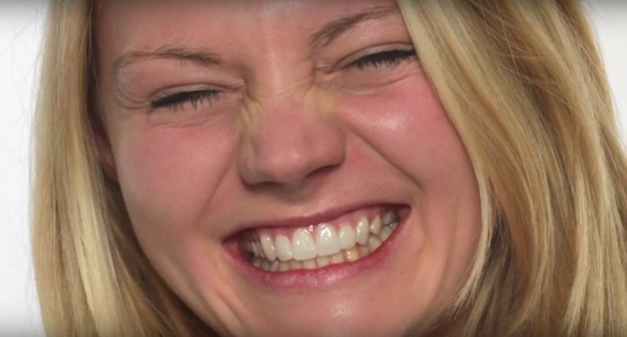 Non prep Veneers – Hochästhetische Versorgungen aus Tübingen