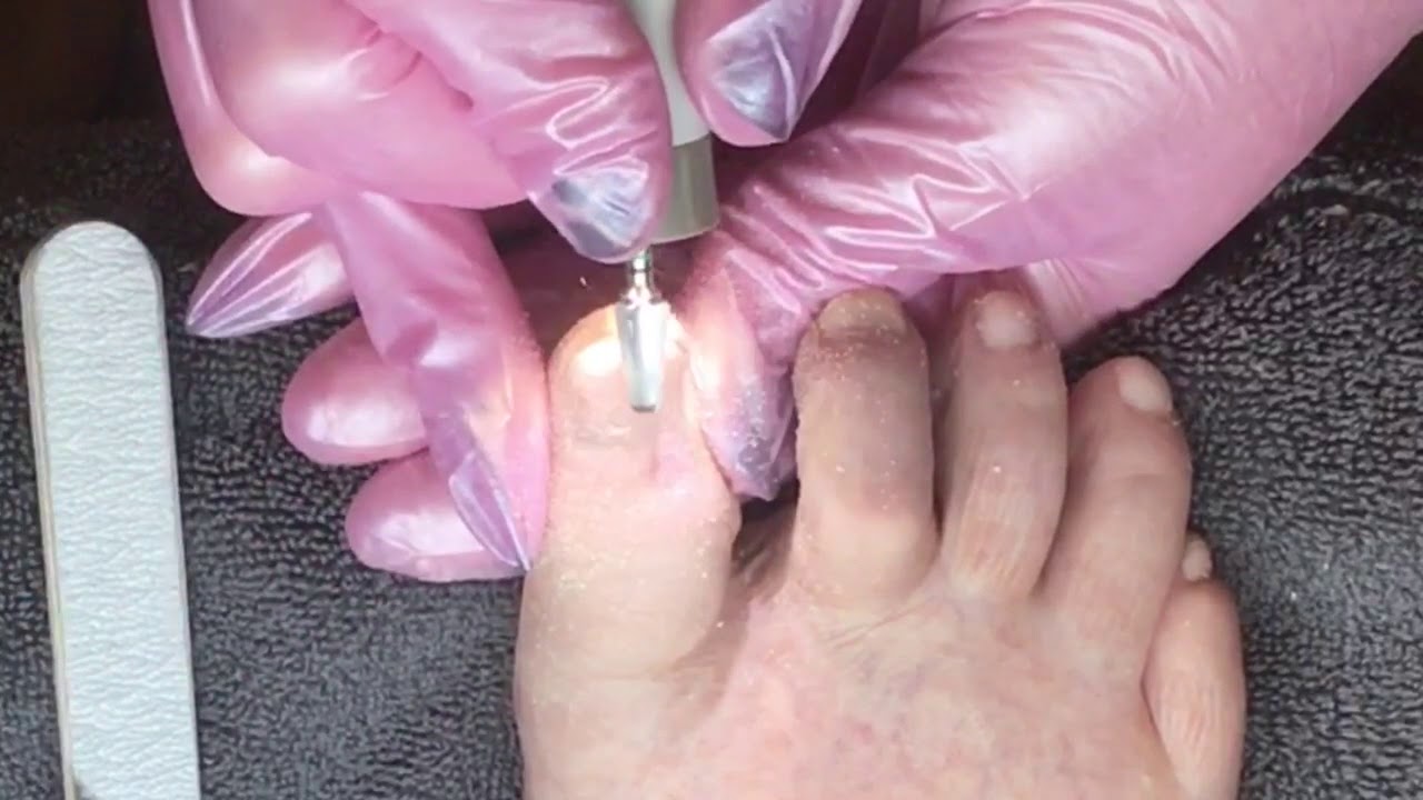 Toenail reconstruction on damaged nail